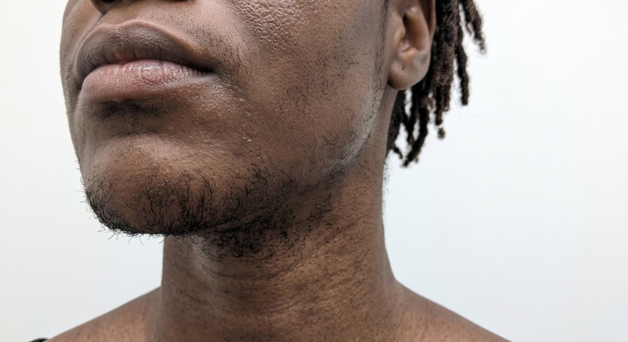 Avant électrolyse - barbe, peau foncée