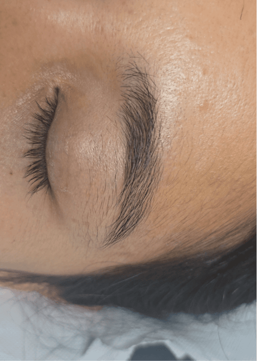 Avant électrolyse - sourcils, poils autour